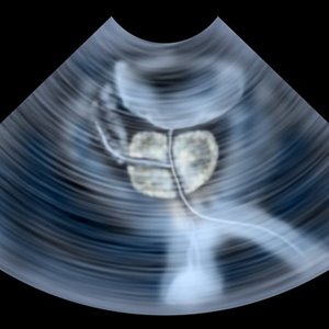 Ultrasound scanner delivers ‘gold standard’ prostate care