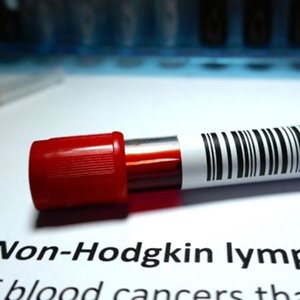 New score to help navigate improved treatment for follicular lymphoma patients
